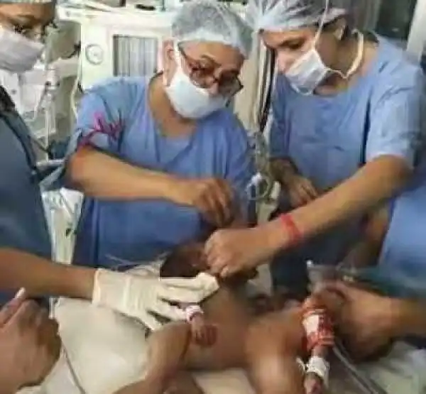 Amazing photos: Conjoined twin sisters undergo successful surgery